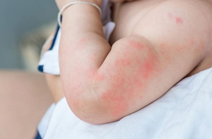 Viêm da tiếp xúc ở trẻ là bệnh gì?