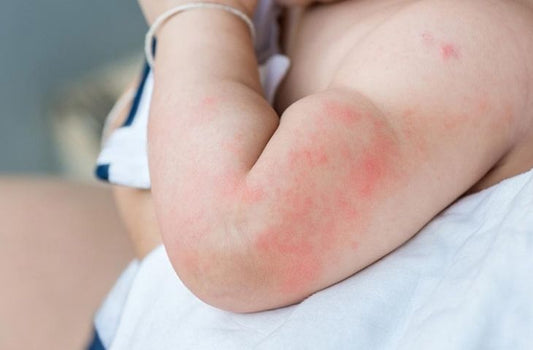 Viêm da tiếp xúc ở trẻ là bệnh gì?