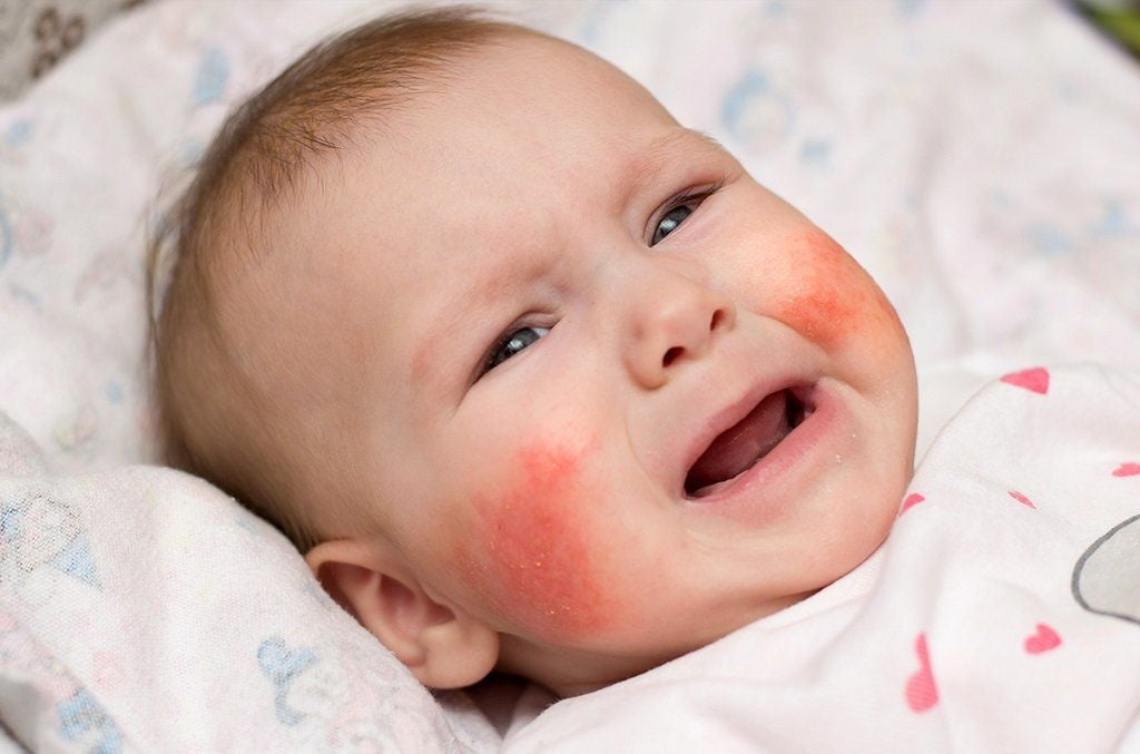 Viêm da cơ địa ở trẻ sơ sinh: Dấu hiệu, nguyên nhân và cách xử trí an toàn cho mẹ