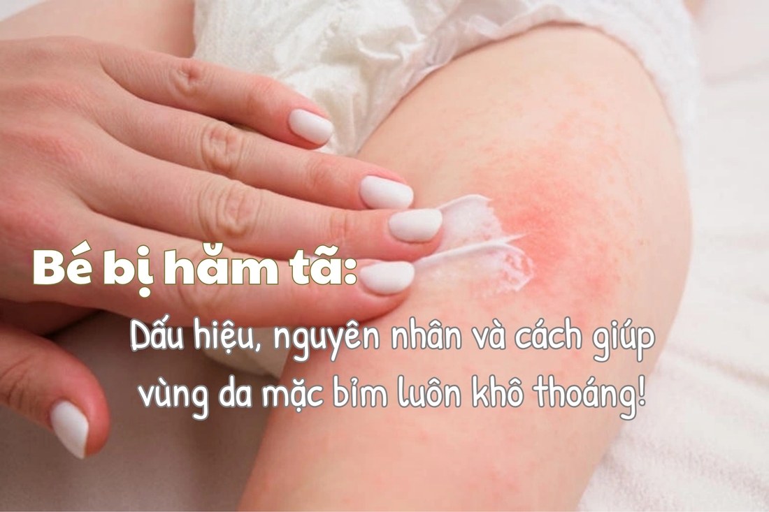 Bé bị hăm tã: Dấu hiệu, nguyên nhân và cách giúp vùng da mặc bỉm luôn khô thoáng